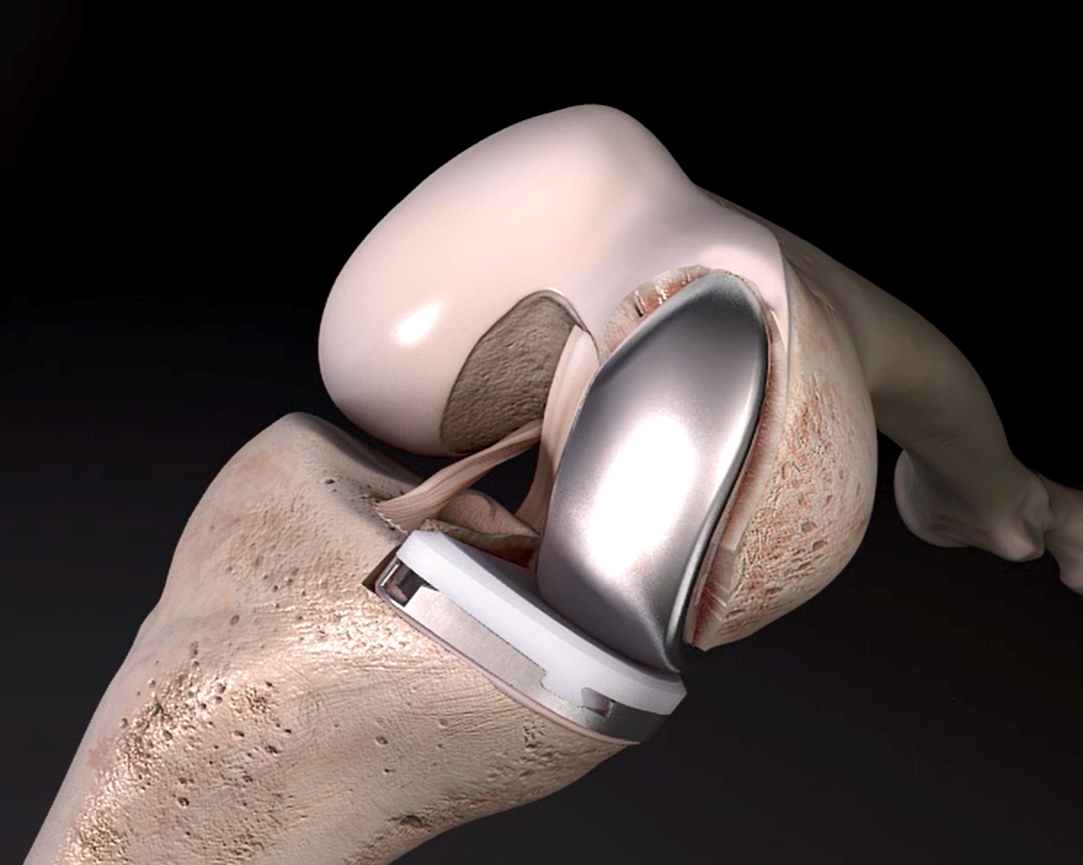 Illustration of a partial knee replacement